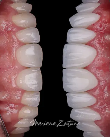 Antes de clareamento dental e odontologia estética