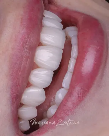 Depois de clareamento dental e odontologia estética